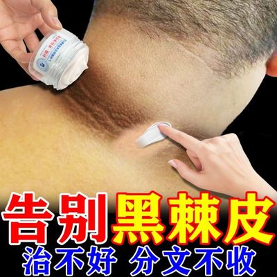 去黑脖子神器黑棘皮病脖子黑的黑棘皮症去除儿童黑色素沉淀磨砂膏
