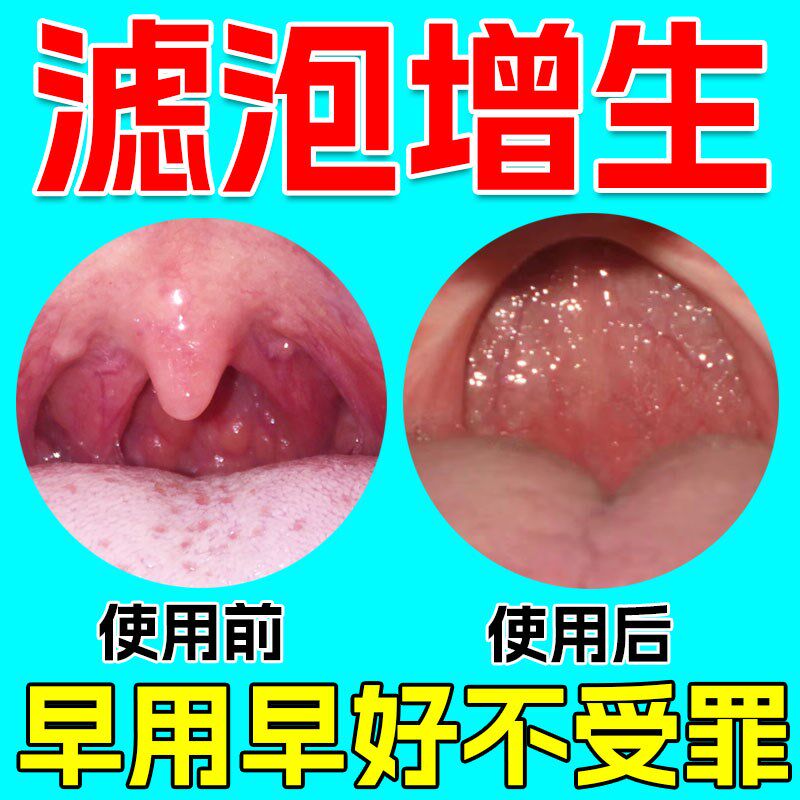 随喷随妤】喉咙滤泡增生咽喉焱淋巴滤泡舌根滤泡干痒咳嗽有异物感