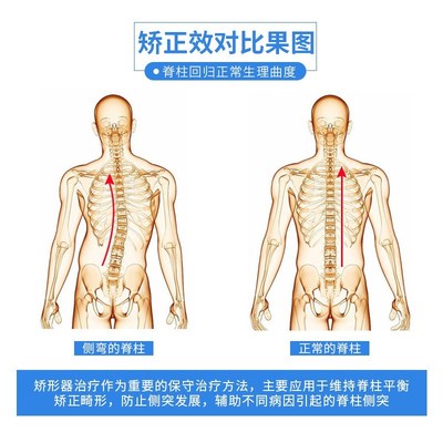 矫正脊柱侧弯支具脊椎腰椎侧凸S弯康复器 儿童高低肩纠正固定支架