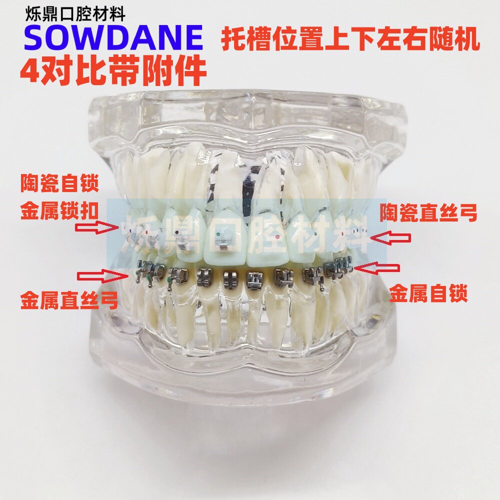 牙科正畸4对比模型金属陶瓷