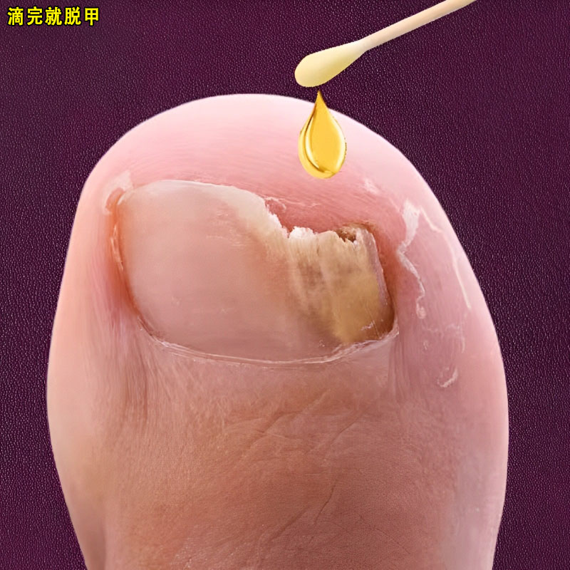 不包不修，轻松去灰指甲