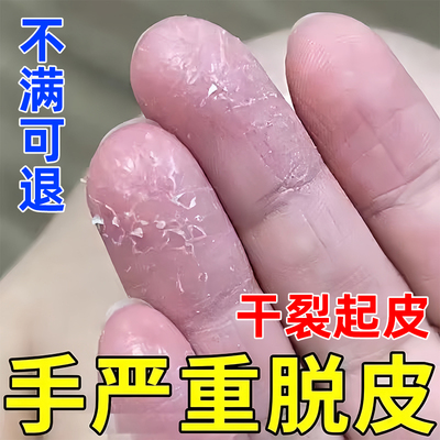 【手足干裂起皮】手足脱皮专用膏