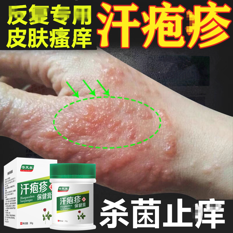 疱疹汗状专用软膏手上起小水泡