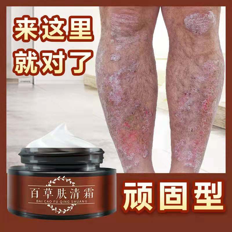 百草肤清霜股藓大腿内侧瘙痒真菌感染体癣藓头癣湿疹专用牛皮癣膏