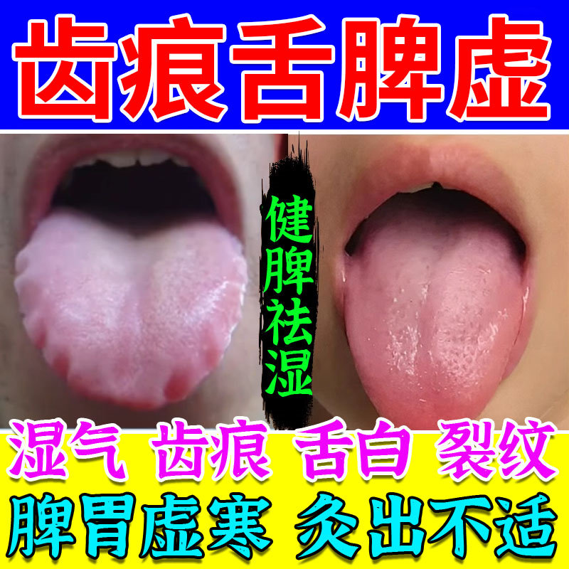 舌头肥大有齿痕舌白调理去脾虚湿气重裂纹脾胃虚弱肝火盛肚脐贴HT