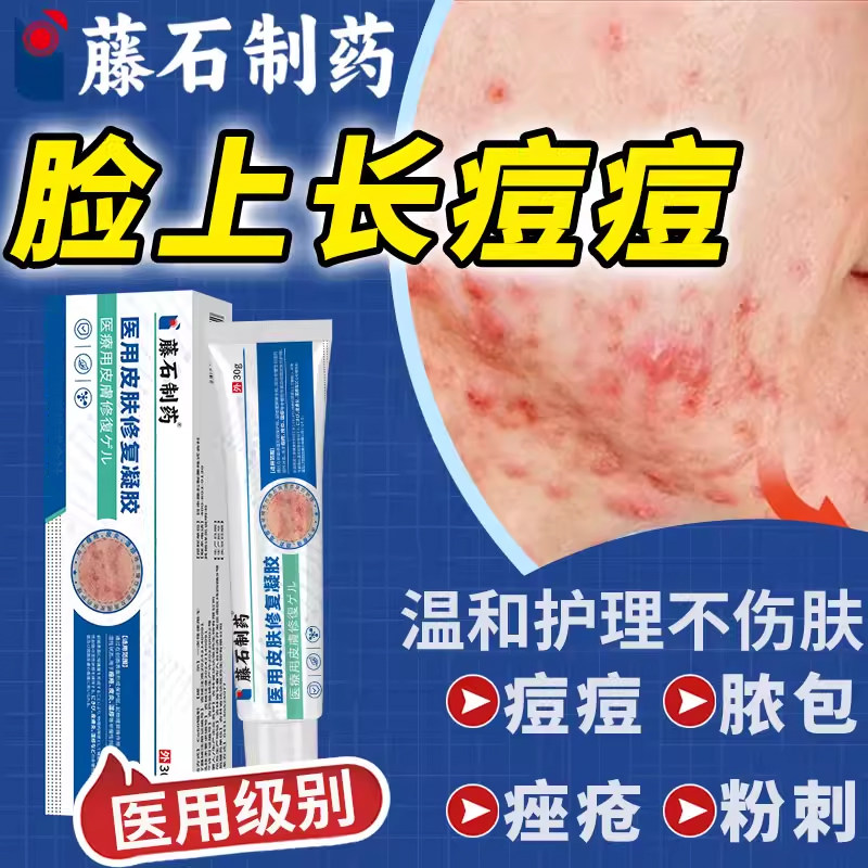 催熟痘痘结节硬块淋巴痘腮边下巴反复长痘硬疙瘩药房同售膏HT
