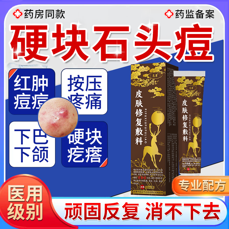 祛石头痘红肿硬块痘痘药房同款膏腮边下巴脸上结节性大疙瘩痤疮TU