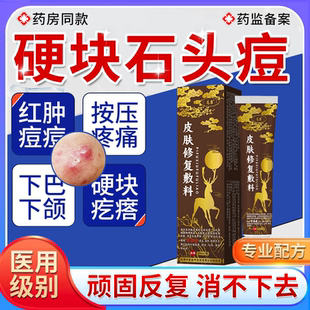 祛石头痘红肿硬块痘痘药房同款膏腮边下巴脸上结节性大疙瘩痤疮TU