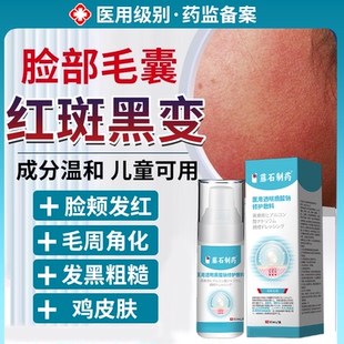面部毛囊红斑黑变病颈部脸颊两边小疙瘩毛周角化症专用药房同售VQ