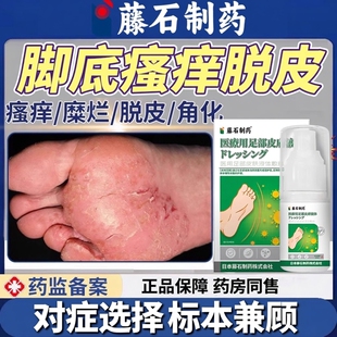 脚气脚癣水疱型足藓脚底痒脱皮起皮真菌感染一次净药房款HT