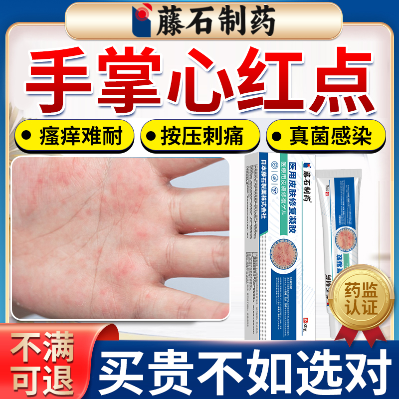 手湿疹手心冒红点刺痛脱皮
