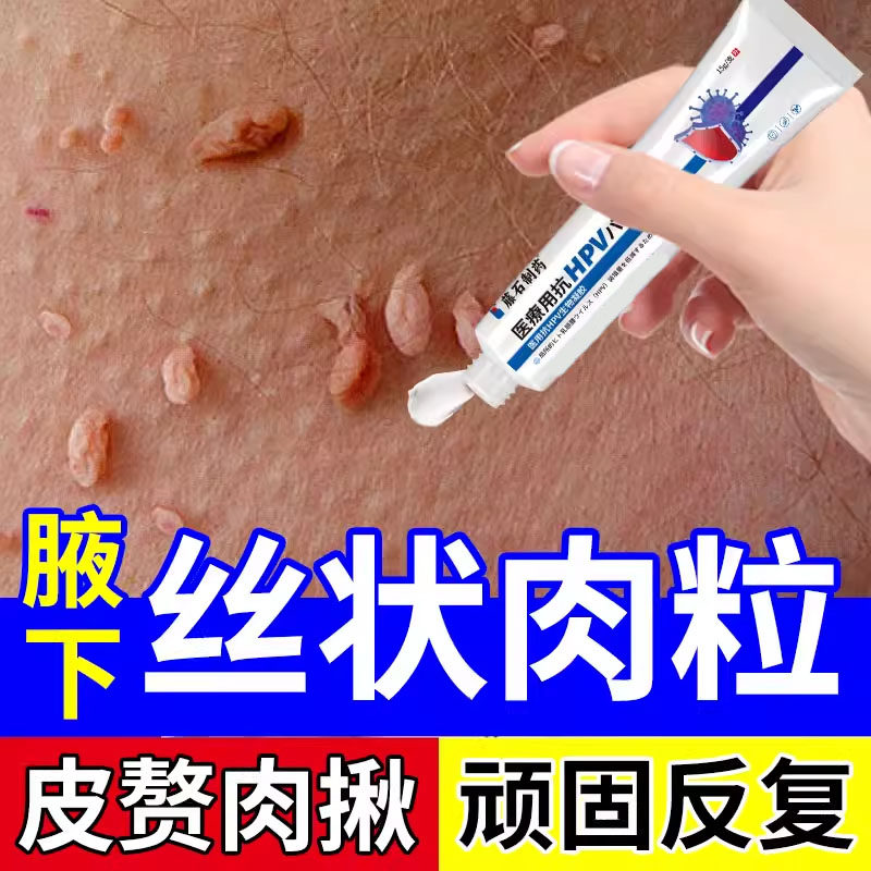 丝状疣庞腋下皮赘去优猴脖子上长小肉粒疣尤瘊去专用膏根医用级TU