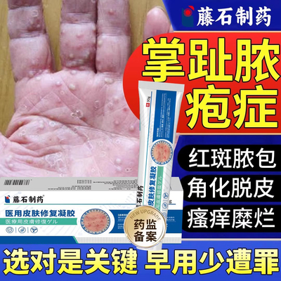 掌趾脓疱病专用皮肤促愈