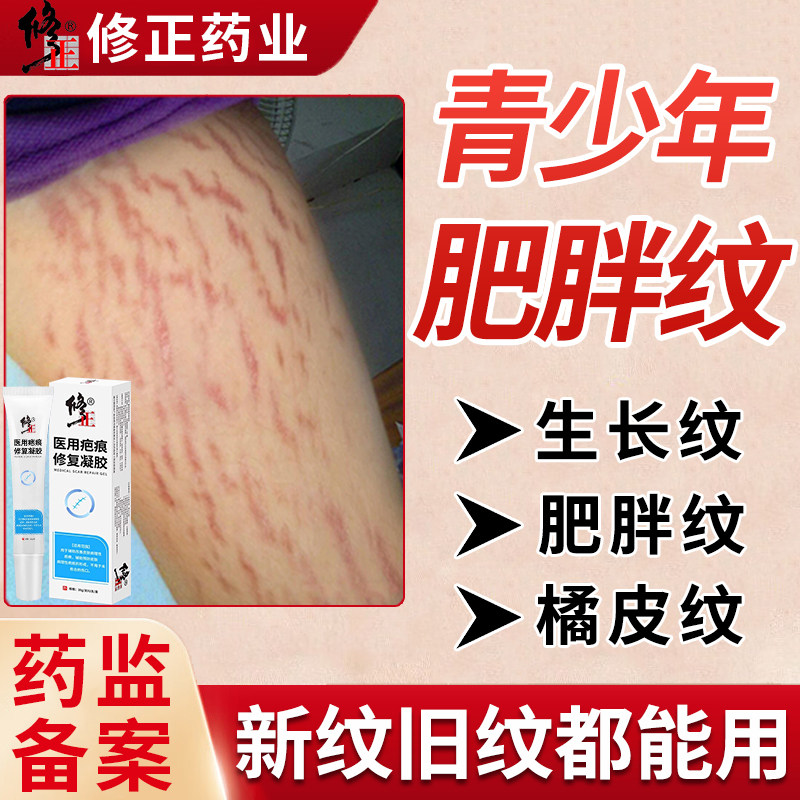 青少年肥胖纹修复霜消除男大腿学生生长纹儿童去除可搭配药膏用wq