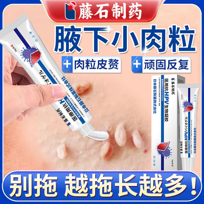 丝状疣腋下小肉粒去除hpv去疣瘊猴专用根皮赘神器药房同售软膏DS