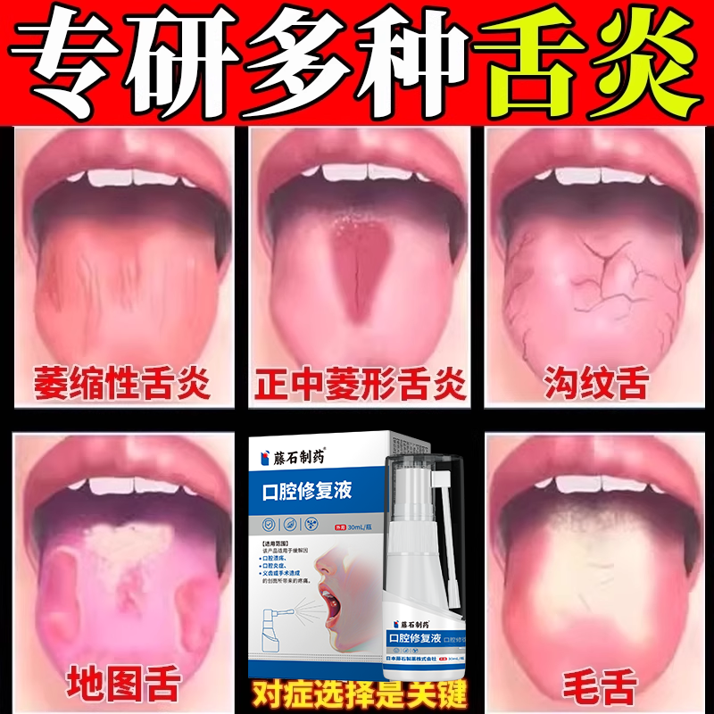 舌康灵--专研多种舌炎--儿童可用