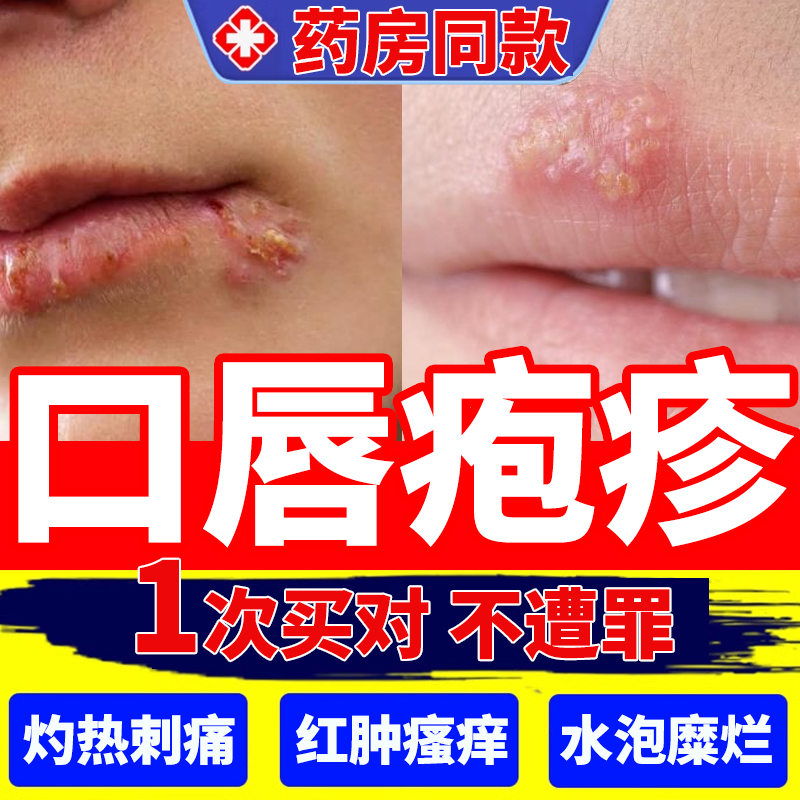 口唇单纯疱疹嘴上嘴巴上火起水泡烂嘴角嘴唇烂起泡膏可搭配药膏ht