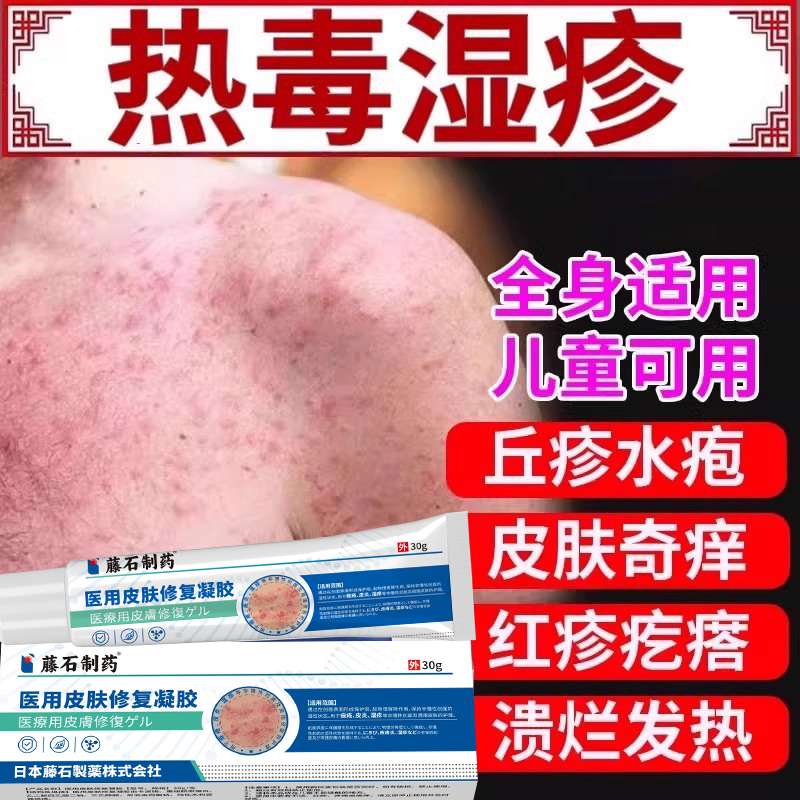 湿疹清热解毒除湿止痒