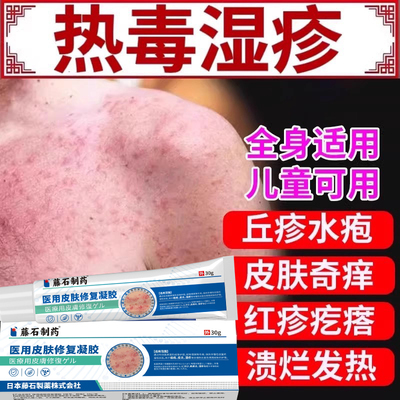 湿疹清热解毒除湿止痒