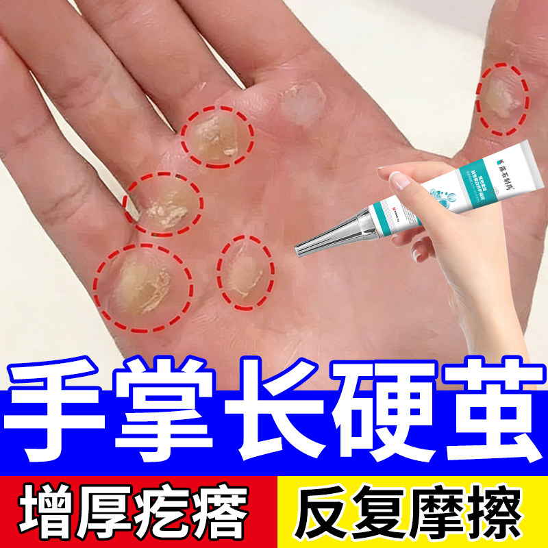 手上长硬疙瘩去死皮手茧老茧去除根软化剂专用指节垫药房同款膏XG