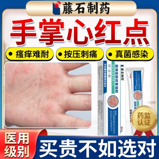 手掌手心红点瘙痒脱皮湿疹专用除湿止痒真菌感染手气汗疱疹水泡HT