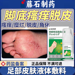 脚气脚癣水疱型足藓脚底痒脱皮起皮真菌感染一次净药房款HT