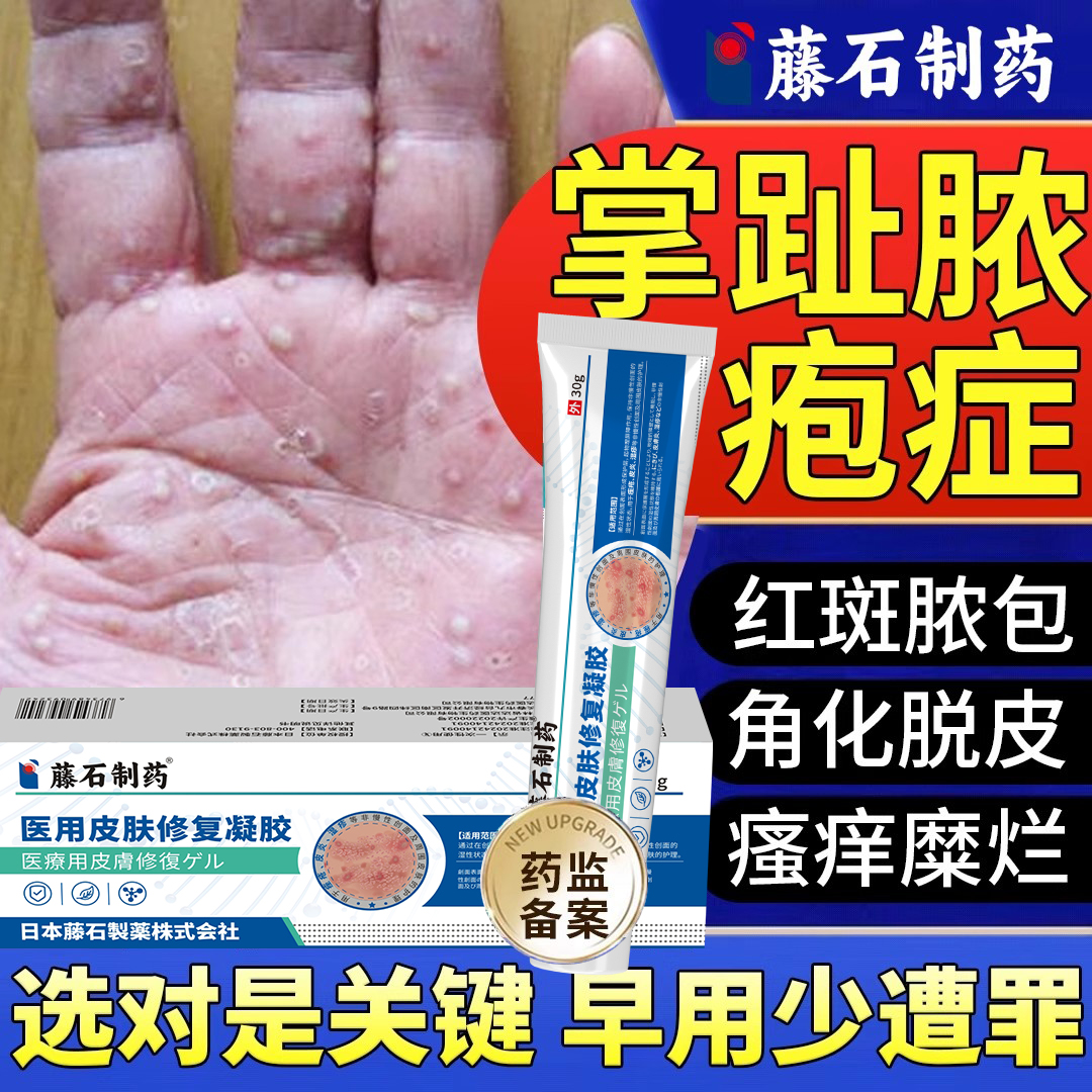 掌趾脓疱病专用皮肤促愈