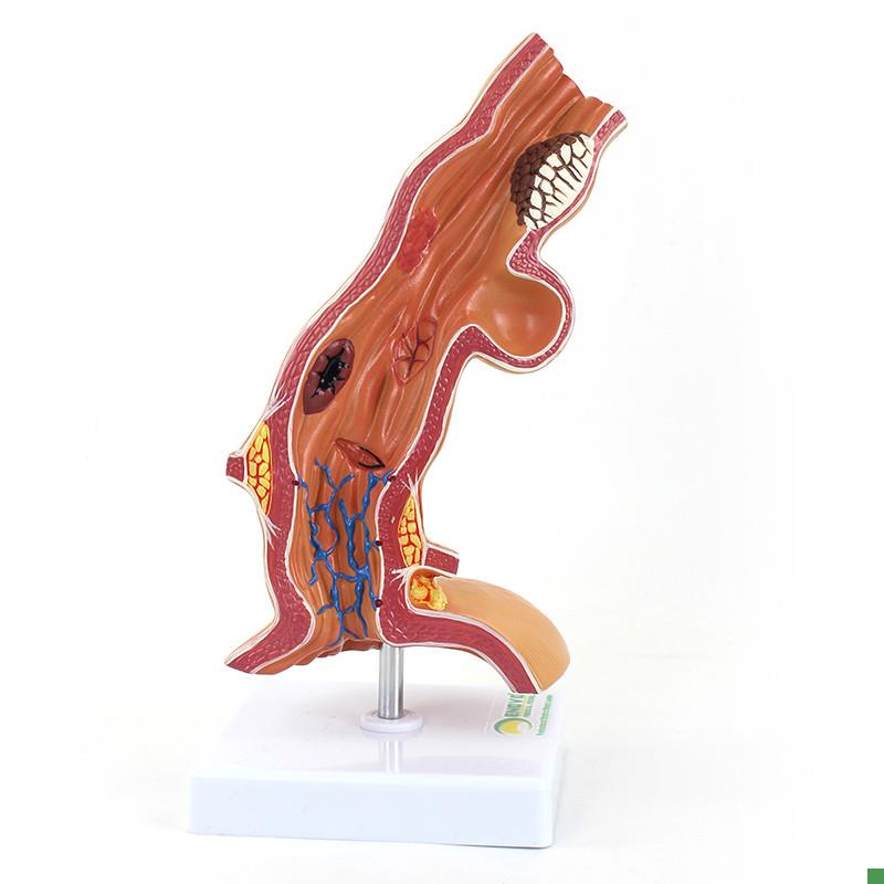 ENOVO颐诺人体食管疾病理模z型医院消化科教学医患沟通解剖模型食