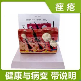 痤疮皮肤模型g病理面部皮肤结构毛囊人体皮肤解剖医美整形医用教