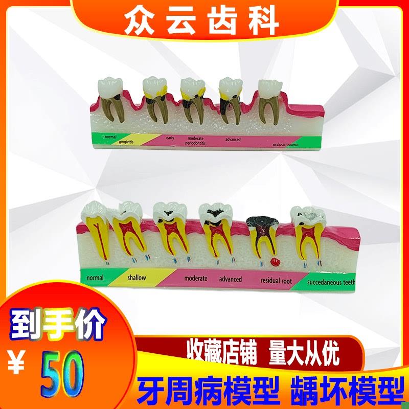 牙齿牙科牙周分类龋坏o模型变重过程牙科口腔医患沟通展示模型包