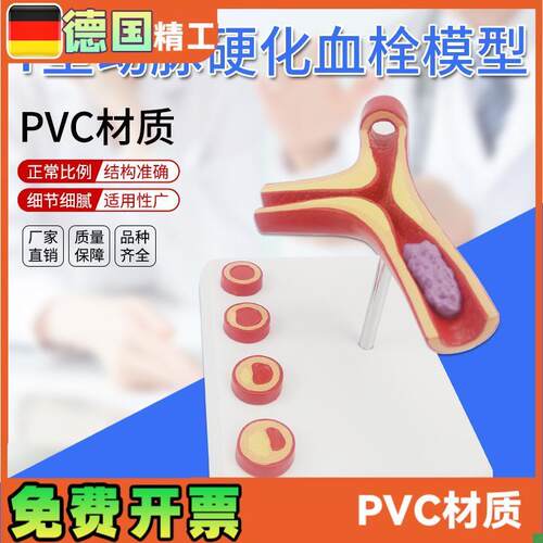 德国】Y型d动脉模型硬化带血栓模型人体血管医学教学模具
