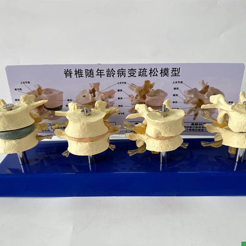 人体脊椎a骨质疏松随年龄病变椎间盘萎缩压缩突出腰椎神经骨骼骨