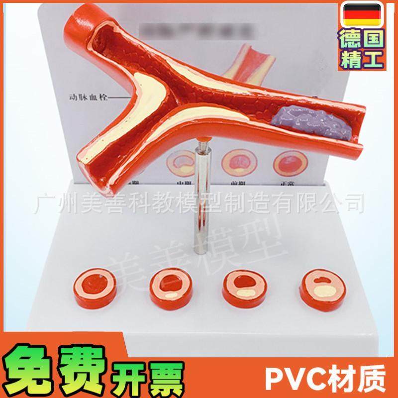 人体支脉粥样硬化l人体血管血管模型血管堵塞老年人血管病理模型