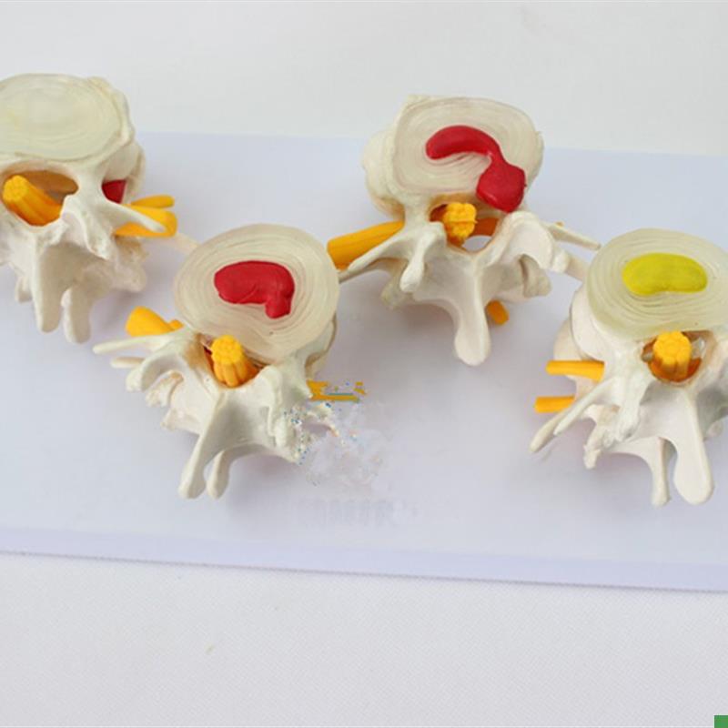 人体四阶段病态正常腰椎比较病变骨骼P标本模具病理模型