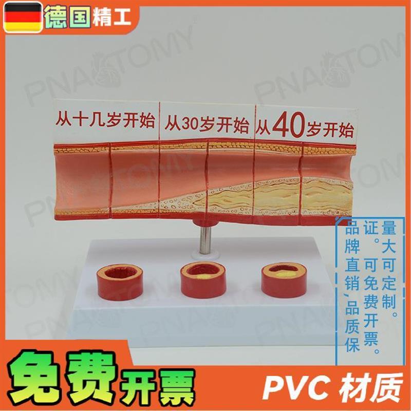 德国】人体动脉血管堵塞模型心脑A血管血栓/硬化模型教学心脑血管