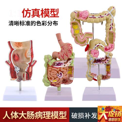 大肠病理模型f 直肠 大肠 肠胃病变解剖 人体肠道疾病结肠病变模
