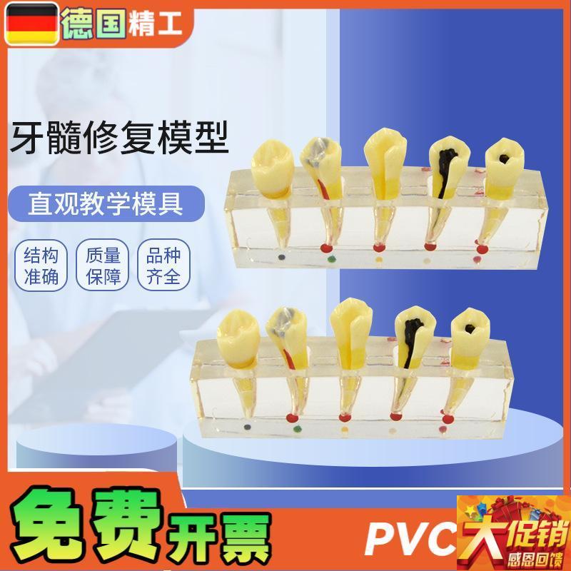 德国牙科医c患沟通病理模型 牙sui病修复模型 展示牙髓龋坏可拆