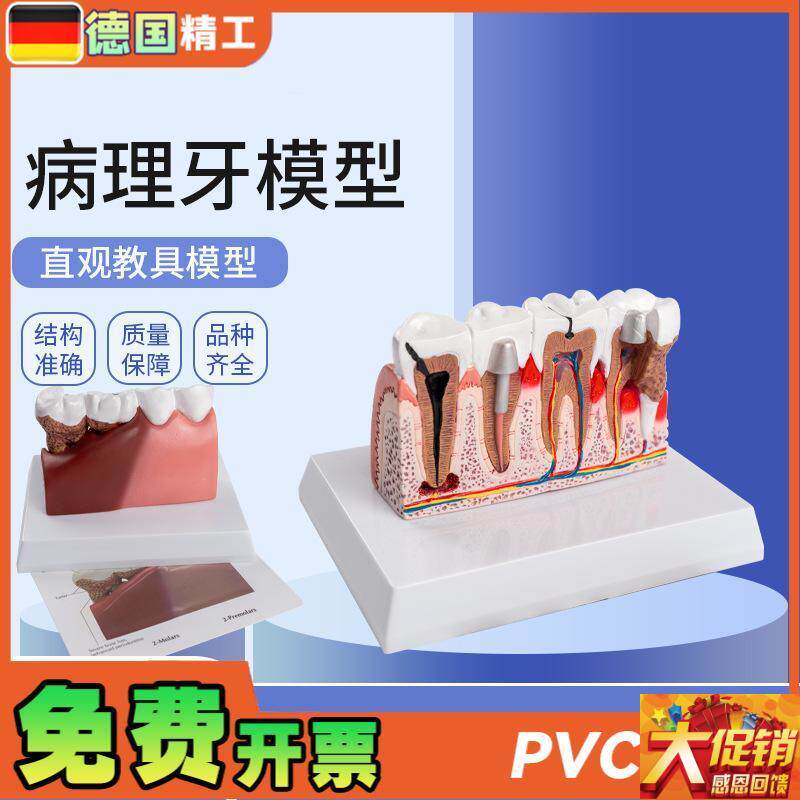 德国】病理牙模型成人病理牙齿x模型 口腔模型牙科教学模型 演示