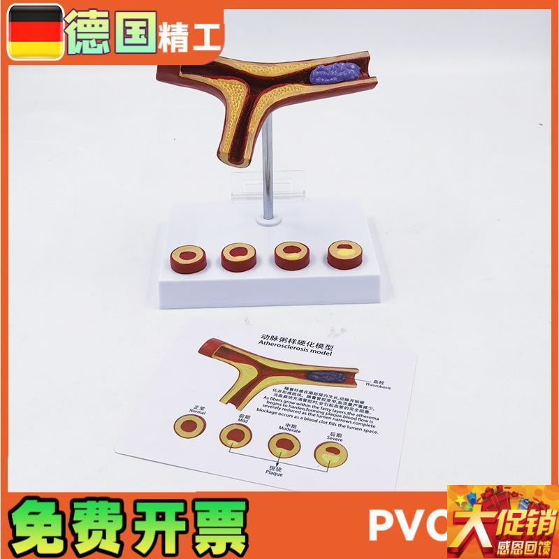 德国】动脉模型血栓冠心血管解z剖教学医药礼品健康管理教具医学