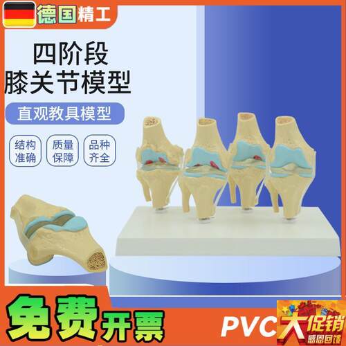 德国】人体膝关节模型 正常与病理对比教具 医药礼品医Z患沟通道