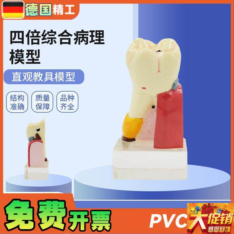德国PNT-OR11四倍综合病理蛀牙模型牙齿病变综合U病理模型牙齿解
