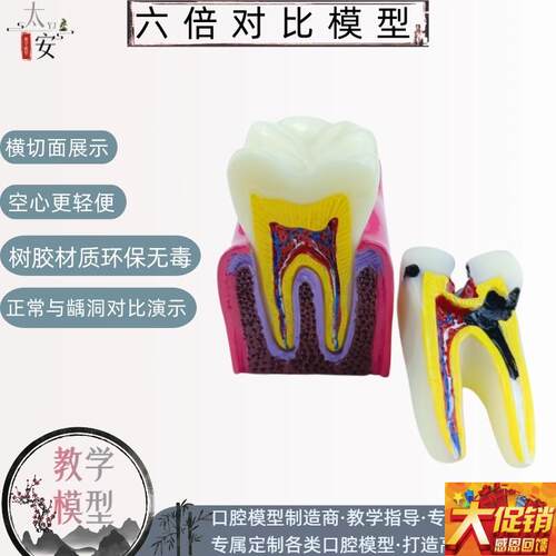 牙科口腔模型解k剖放大蛀牙模具医患沟通六倍牙齿龋坏病理演示