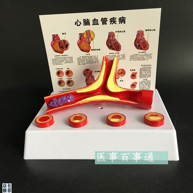 血管模型冠状动脉性心脏病动脉化模型老年科医患沟Y通演示模型