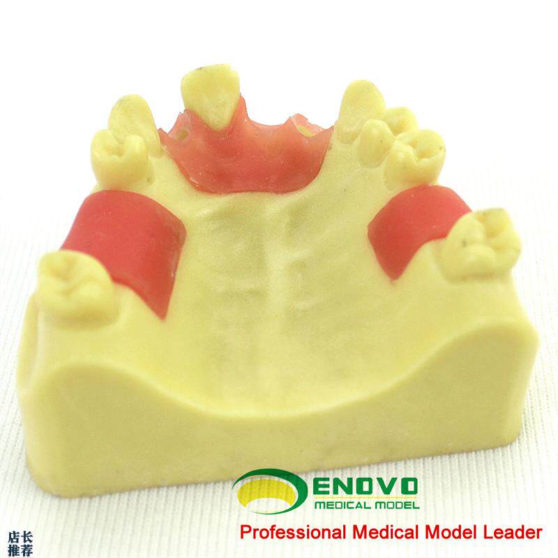 ENOVO颐诺上颌缺失种植实训模型口腔I即刻种植操作上颌骨缺失牙齿