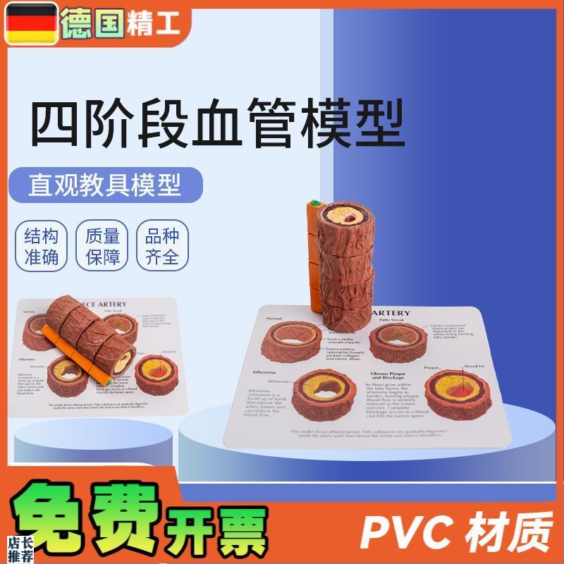 德国】血管模型h人体四阶段血管标本心内科医患沟通演示血管硬化
