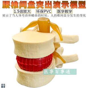 脊柱模型脊椎骨头腰椎间盘模w具椎体模型突出受压病理骨质教具包