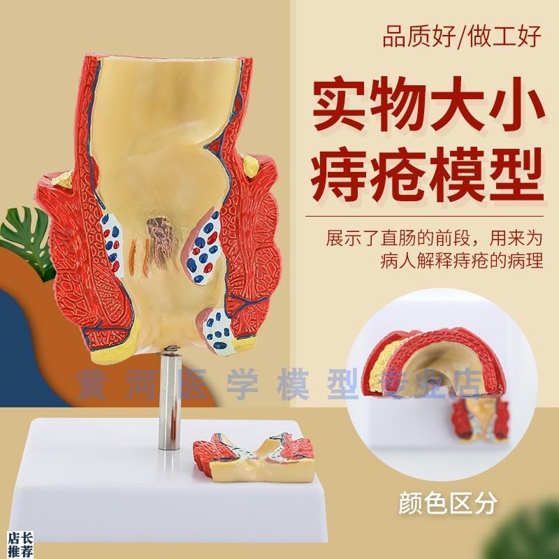 人体直肠病变模型病理直肠模型病理痔疮肛P门医患沟通教学模型