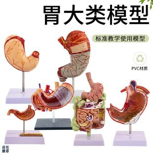 病理胃模型人体胃的穿孔病态胃A模型消化科胃冠状剖面解剖放大