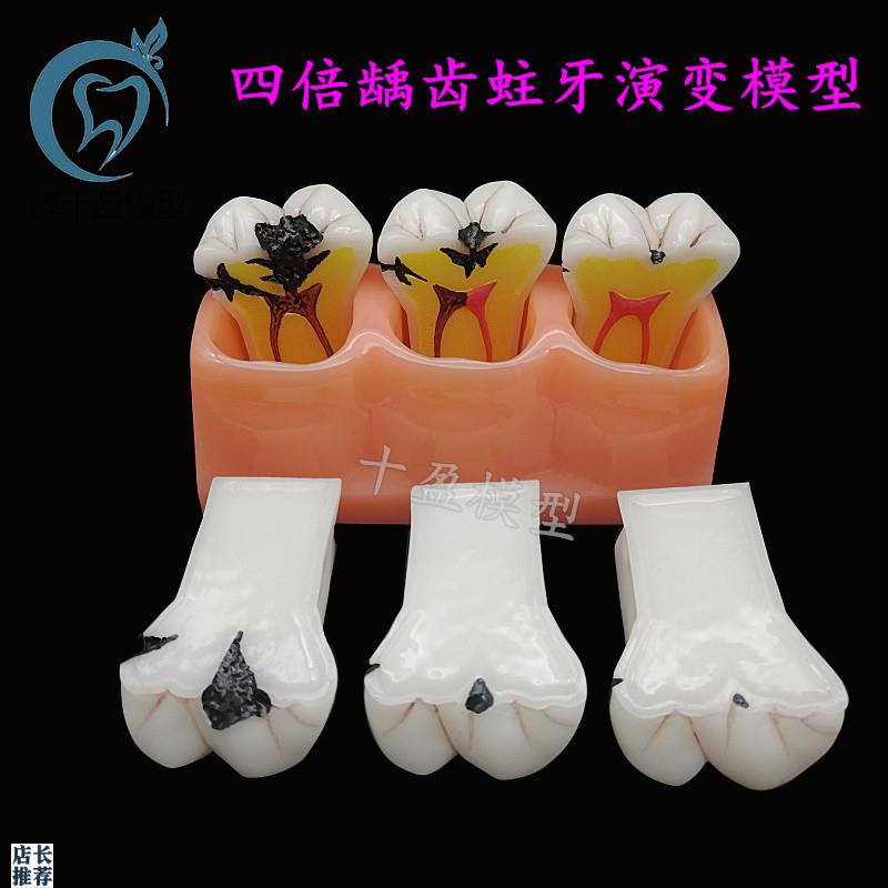 牙齿模型四倍龋齿演变模型蛀牙演示医患沟通龋P齿发展病理分解模M