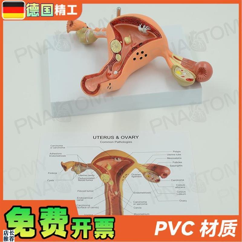 德国】女性子宫卵巢病理病变模型生殖科妇N产科教学计生医学教学
